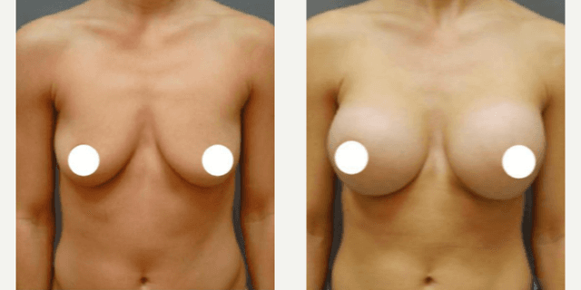 Breast Augmentation procedure image