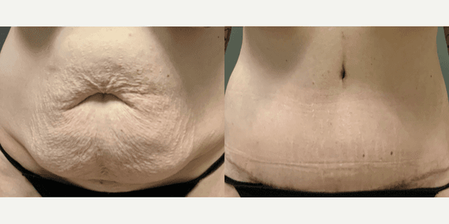 Tummy Tuck (Abdominoplasty) procedure image