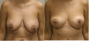 Mommy Makeover procedure image