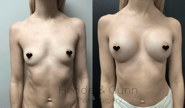 Breast Augmentation procedure image