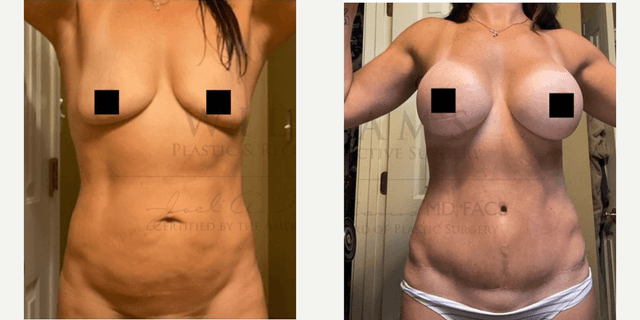 Mommy Makeover procedure image