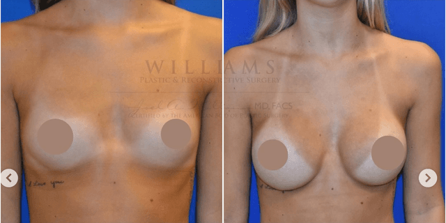 Breast Augmentation procedure image