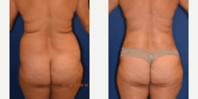 Brazilian Butt Lift (BBL) procedure image