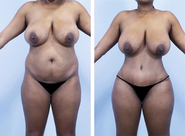 Mommy Makeover procedure image