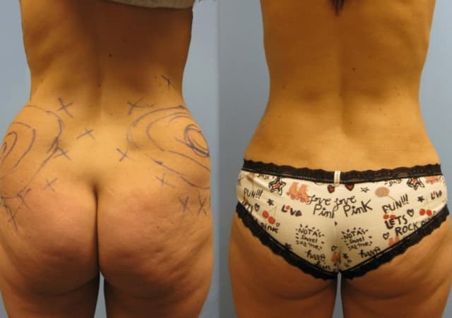 Brazilian Butt Lift (BBL) procedure image