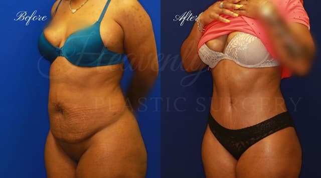 Liposuction procedure image