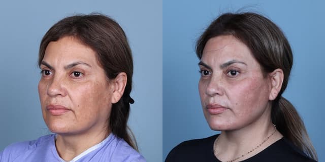 Rhinoplasty (Nose Job) procedure image