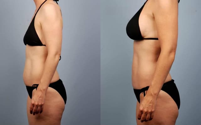 Body Lift procedure image