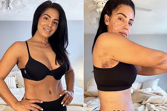 Lipo 360 procedure image