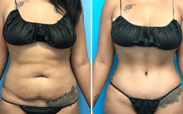 Mommy Makeover procedure image