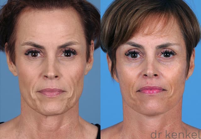 Facelift procedure image