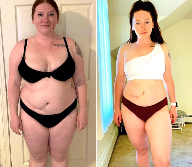 Tummy Tuck (Abdominoplasty) procedure image