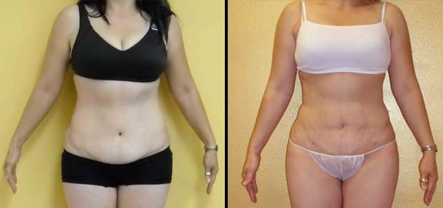 Mommy Makeover procedure image