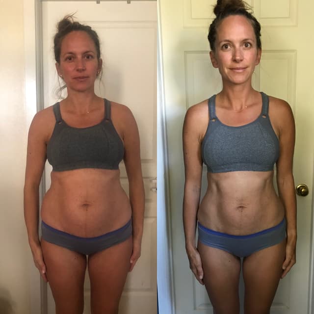 Body Lift procedure image