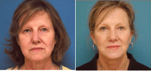 Facelift procedure image