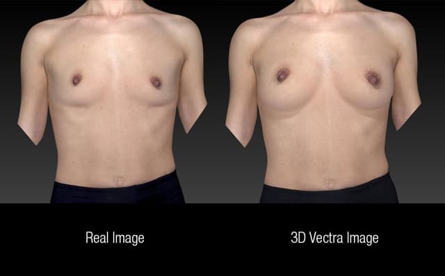 Breast Augmentation procedure image