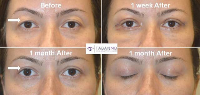 Eyelid Surgery (Blepharoplasty) procedure image