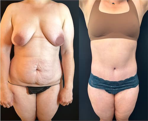 Mommy Makeover procedure image