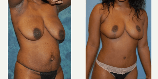 Mommy Makeover procedure image