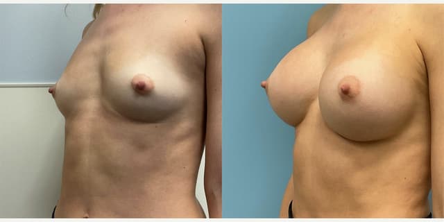 Breast Augmentation procedure image