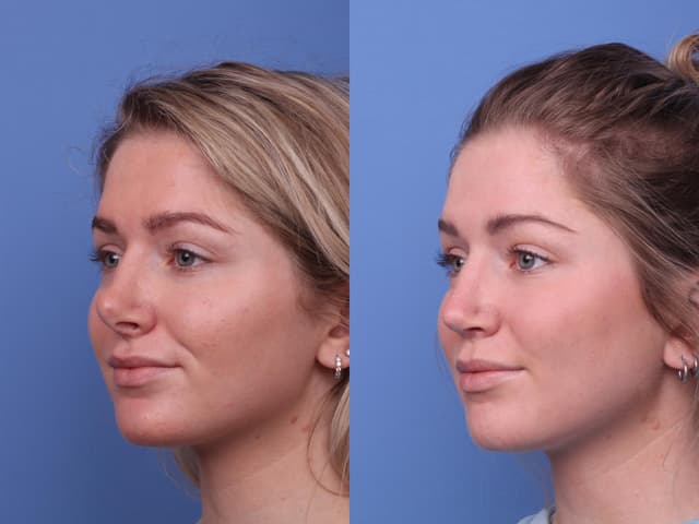Rhinoplasty (Nose Job) procedure image