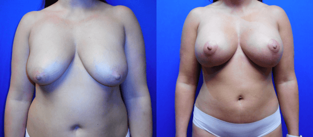 Lipo 360 procedure image