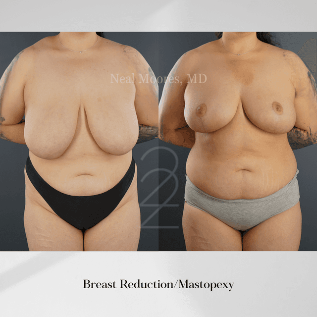 Tummy Tuck (Abdominoplasty) procedure image