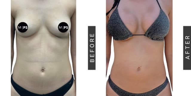 Breast Augmentation procedure image