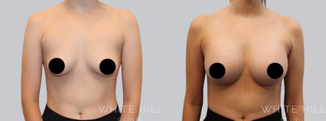 Breast Augmentation procedure image