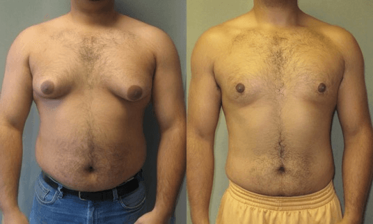 Gynecomastia procedure image