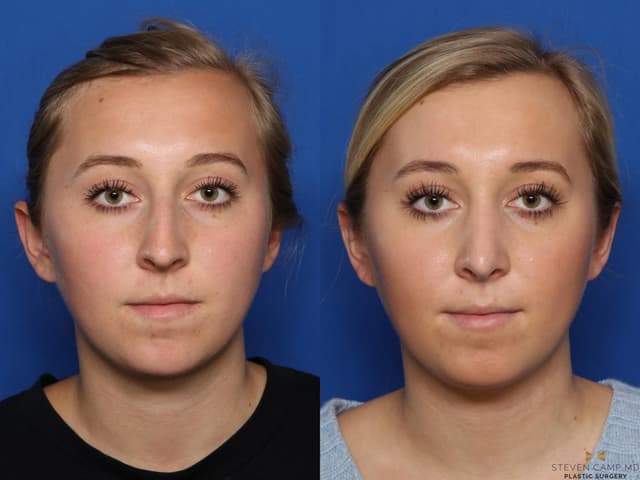 Rhinoplasty (Nose Job) procedure image