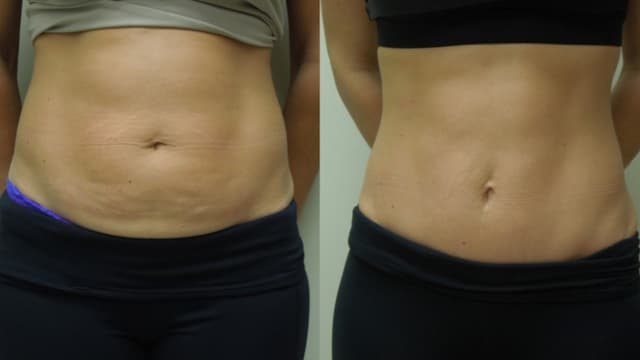 Lipo 360 procedure image