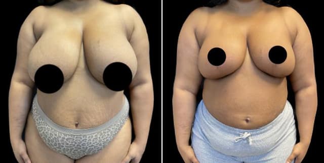 Breast Augmentation procedure image