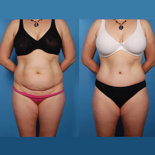 Mommy Makeover procedure image