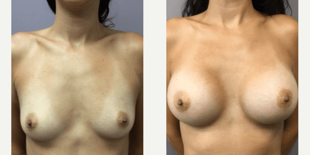 Breast Augmentation procedure image