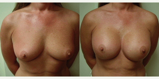 Mommy Makeover procedure image