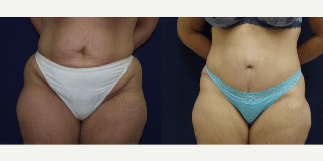 Tummy Tuck (Abdominoplasty) procedure image