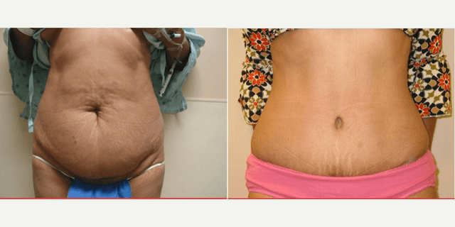 Mommy Makeover procedure image