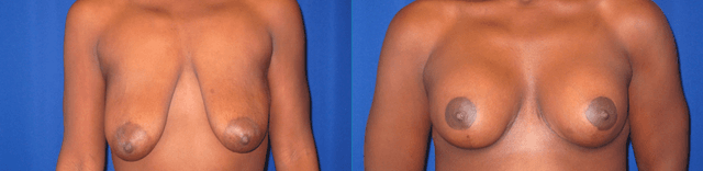 Breast Augmentation procedure image