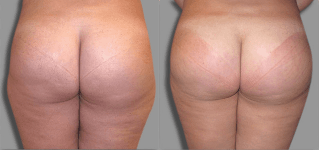 Brazilian Butt Lift (BBL) procedure image