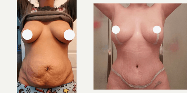 Breast Augmentation procedure image