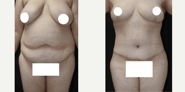 Mommy Makeover procedure image