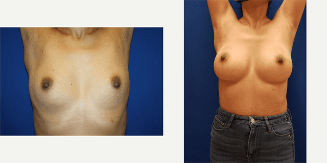 Mommy Makeover procedure image