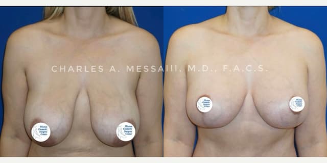 Breast Augmentation procedure image