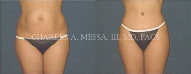 Skin Tightening procedure image