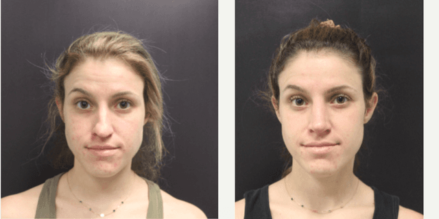 Rhinoplasty (Nose Job) procedure image