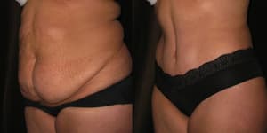 Mommy Makeover procedure image