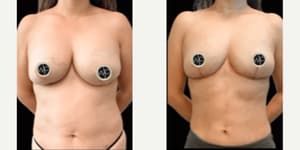 Breast Augmentation procedure image