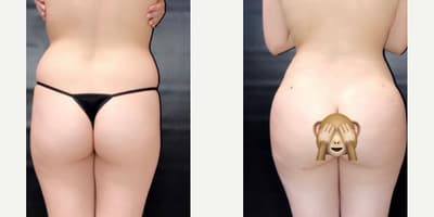 Brazilian Butt Lift (BBL) procedure image