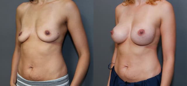 Mommy Makeover procedure image